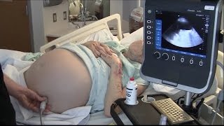 Ultrasound for Paracentesis  BAVLS [upl. by Crichton]