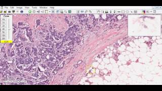 Breast ductal carcinoma Breast cancer [upl. by Bondy245]