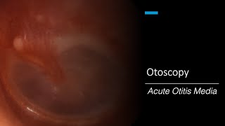 Acute Otitis Media Otoscopy [upl. by Ednalrim]