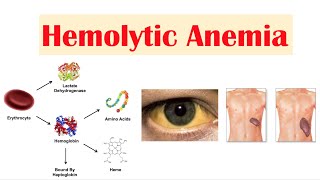 Hemolytic Anemia [upl. by Kasevich]