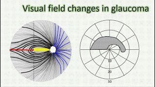 Visual field changes in glaucoma [upl. by Xavier]