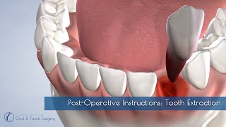 PostOperative Instructions Tooth Extraction [upl. by Nadbus211]