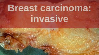 Breast Carcinoma Invasive  Pathology mini tutorial [upl. by Greenberg462]