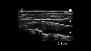 Image Interpretation Carotid Atherosclerosis [upl. by Adnav614]