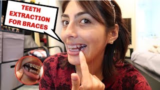 TEETH EXTRACTIONS FOR BRACES [upl. by Ranice320]