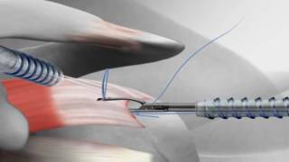 Rotator Cuff Repair with Arthrex® SutureBridge™ [upl. by Aleil]