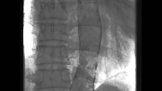 Introduction to Cardiac Heart Anatomy and the Chest Xray [upl. by Lowrance967]