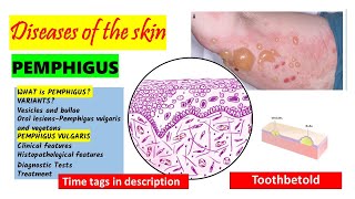 Pemphigus Vulgaris  HISTOPATHOLOGY  Immunofluorescence  Treatment  PART 22 [upl. by Vachel]