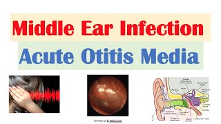 Middle Ear Infection Acute Otitis Media  Causes Symptoms Diagnosis Treatment [upl. by Perren]