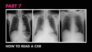 Which calcifications on mammogram are bad [upl. by Ennairol]