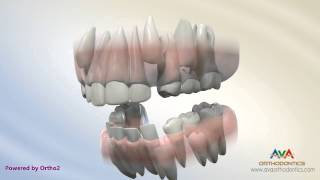 Orthodontic Treatment for Severe Crowding  Serial Extraction [upl. by Assilem67]