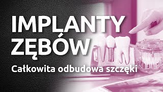 Implanty zębów Całkowita odbudowa szczęki przy zastosowaniu implantów XIVE [upl. by Aleyam]