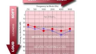 How to Read an Audiogram [upl. by Jarv]