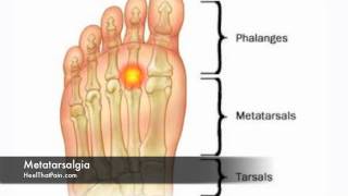 Metatarsalgia Foot Pain Causes Symptoms amp Treatments [upl. by Aver691]