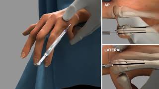 Bioretec ActivaPin™ 5th Metacarpal fracture fixation [upl. by Solange240]