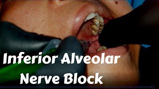 Inferior Alveolar nerve Block Injection in dentistry Landmark amp Technique in Dental Teeth Surgery [upl. by Dylana489]