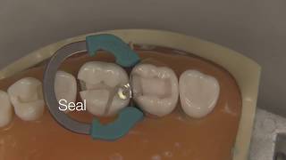 Class II Composite Restoration  Stevenson Dental Solutions [upl. by Aitel781]