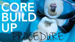 Root Canal Demonstration  Core Build Up Procedure [upl. by Baugh]