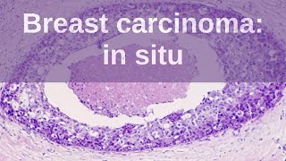 Breast Carcinoma in situ  Pathology mini tutorial [upl. by Anitnerolf244]