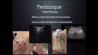 US Guided thoracentesis CUSE 2018 [upl. by Llacam]