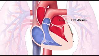 Mitral Valve Regurgitation [upl. by Irra]