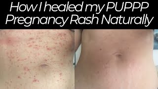 How I Healed my PUPPP Pregnancy Rash Naturally [upl. by Aloin]