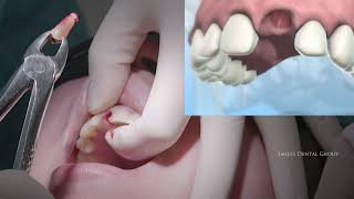 LIVE SURGERY DENTAL EXTRACTION AND BONE GRAFT [upl. by Latashia]