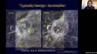 Dense Calcification in the Aorta [upl. by Iek]