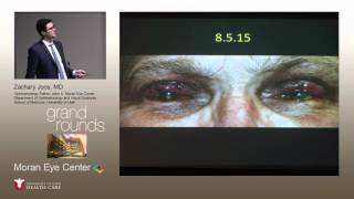 Ocular Cicatricial Pemphigoid Multidisciplinary Approach [upl. by Nosyt]