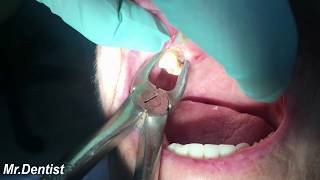 Extraction Of Molar Tooth [upl. by Yeroc]