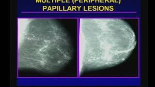 Management of Papillary Breast Lesions [upl. by Otxis]